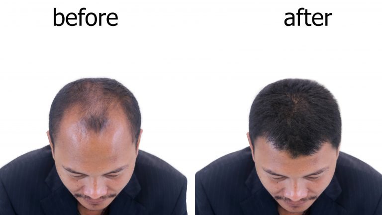 Hair restoration